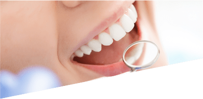 blanchiment dentaire professionnel