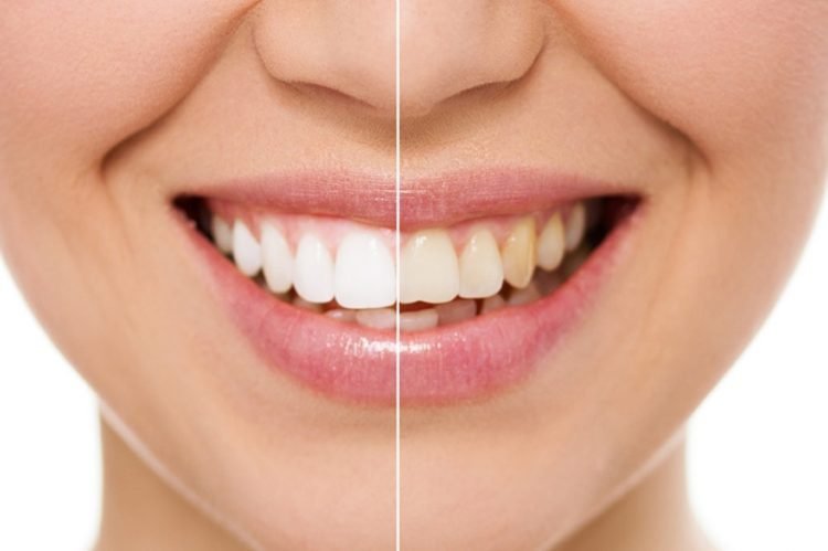 blanchiment dentaire avant apres