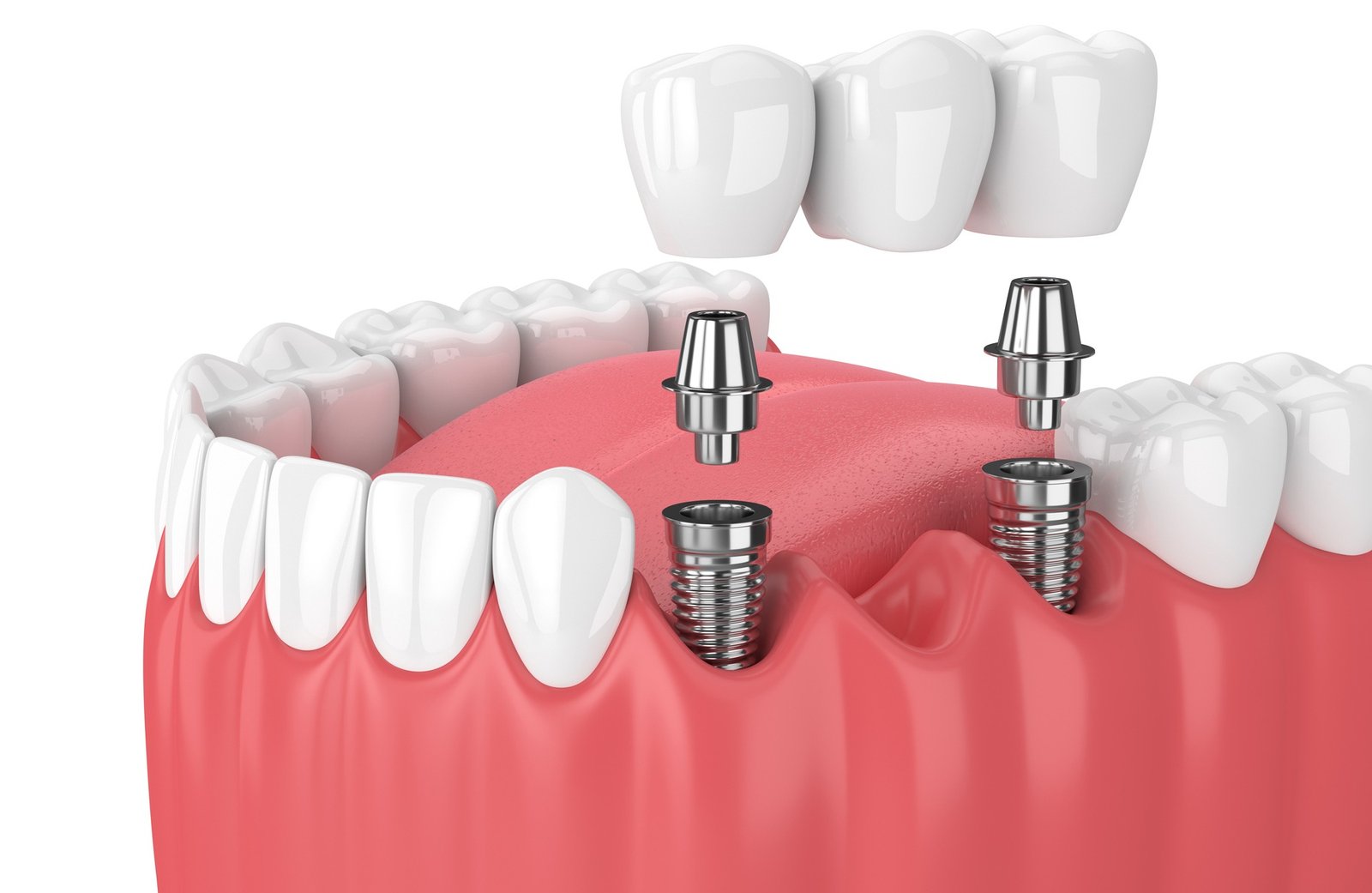 Implant dentaire Hongrie : Prix implantologie dentaire pas ...