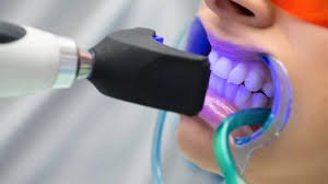 blanchir dents au laser