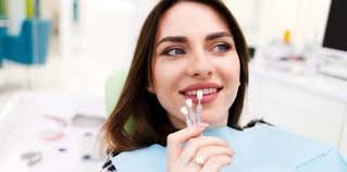 Facette veneers tunisie