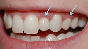 intervenir sur les gencives