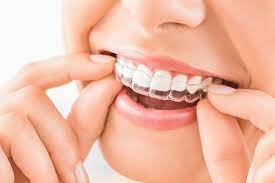 avantages Orthodontie Invisalign