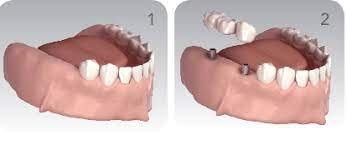 solutions édentation partielle