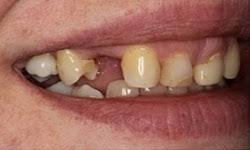 édentation dentaire partielle