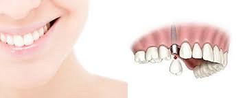 édentation partielle