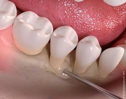 regeneration tissulaire