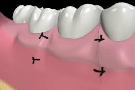 régénération tissulaire guidée