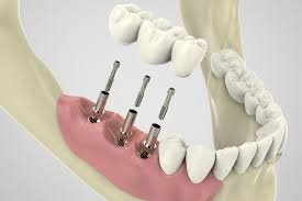 procedure implant dentaire