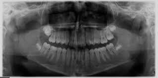 diagnostic chevauchement dentaire