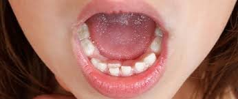 encombrement dentaire chez enfants