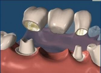 options remplacement dents
