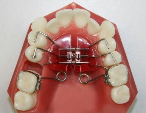 prothèse pour dents manquants