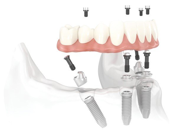 solution perte dents