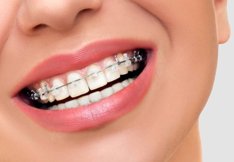 appareils dentaires tunisie