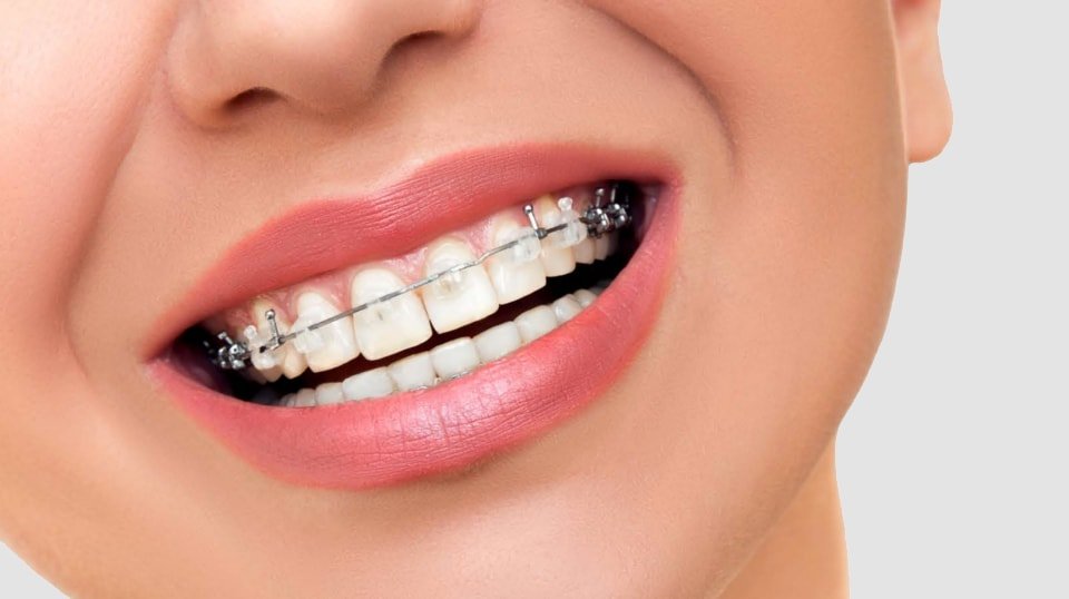 appareils dentaires tunisie