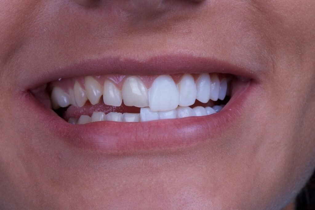 caractéristiques des facettes veneers