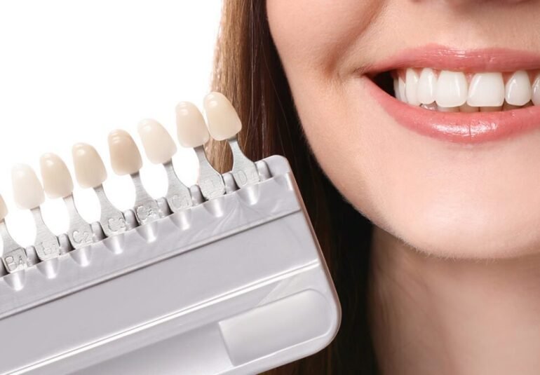 facettes veneers tunisie