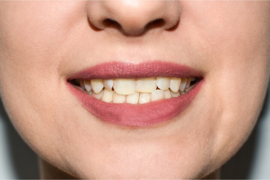 usages facette dentaire pour dent tordue