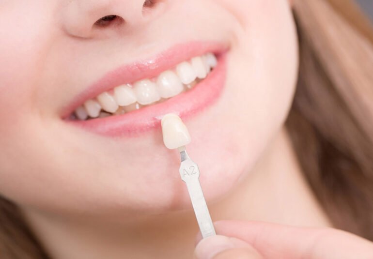 facette dentaire pour dent tordue