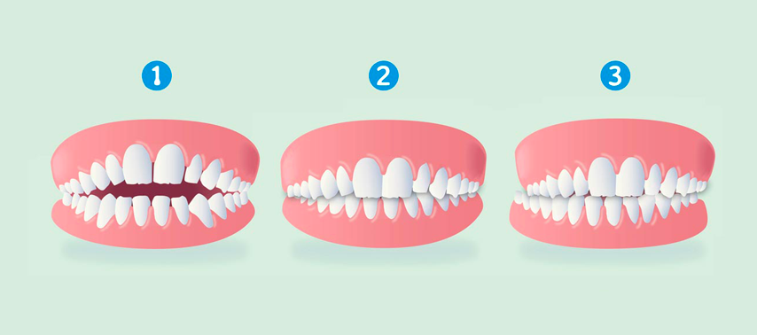 types malocclusion dentaire