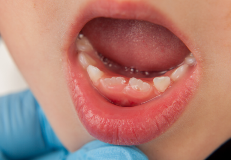 dents tordues enfant