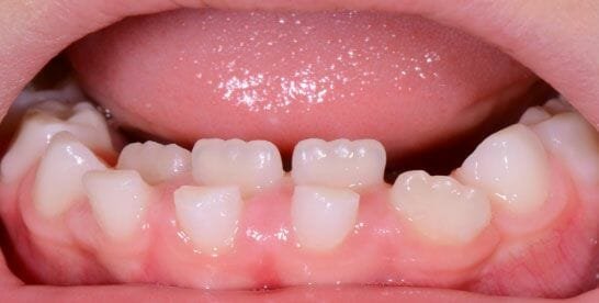 dent tordue enfant pourquoi