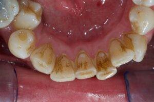 impact tabac sur dents