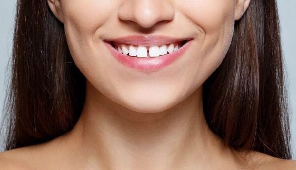 diastèmes ou espace entre les dents