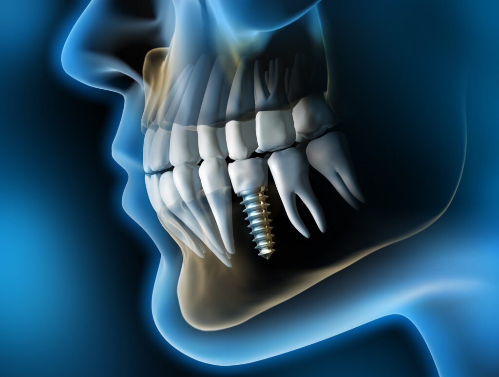 durée de vide d'implant dentaire