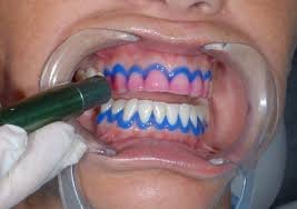 traitement de blanchiment de dents