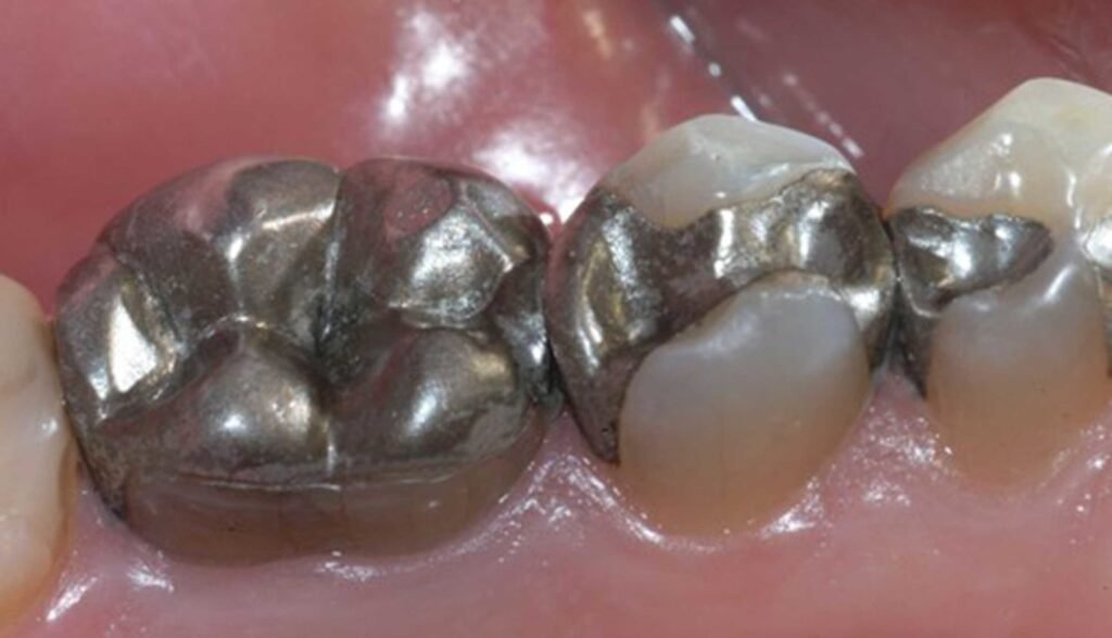 types de remplissage dentaire